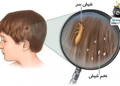 درمان خانگی شپش موی سر