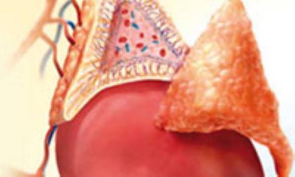 بیماری آدیسون (نارسایی غده فوق کلیوی )